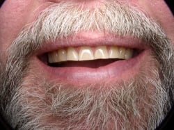 Fig1 Full Smile Before