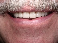 Fig18 More Pleasing Smile