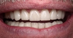 Fig20 Lower Restorations Added