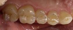 Fig3 Excessive Tooth Wear