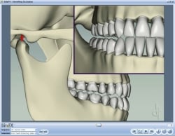 Fig6 Animation Showing Side Anterior Guidance