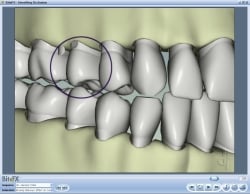 Fig7 Animation Showing Abfraction