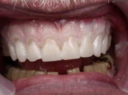 Fig17 Provisionals in the Mouth