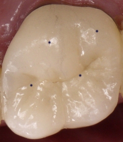 Fig5 Good Molar Contacts
