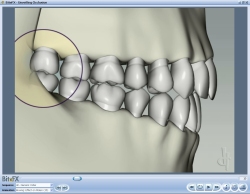 Fig8 Animation Showing Bruxing Effect On Molar