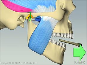 Splint Removal Animation Snapshot