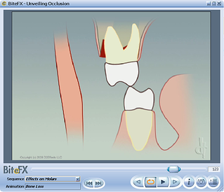 Tooth mobility animation for use by dental hygienist