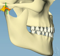 Unstable Bite in MIP