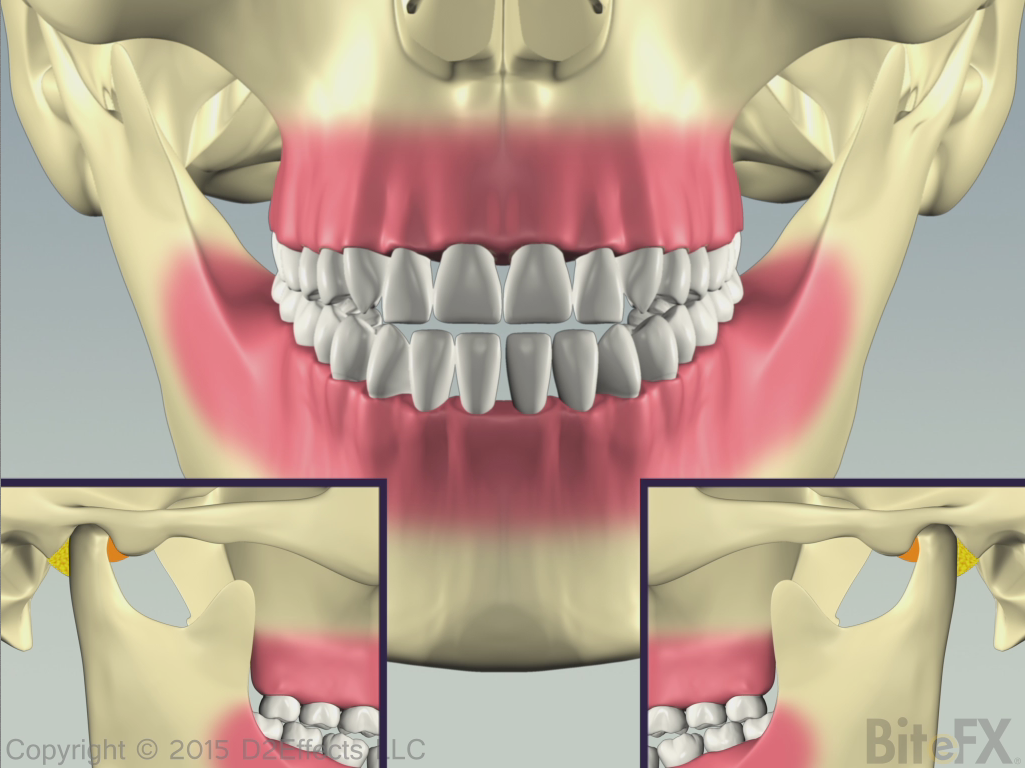 Bilateral-Condyle-Deterioration