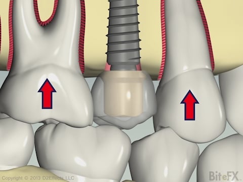 PDL Flex with Implant Animation