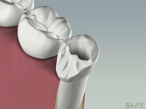 Buccal Cusp Fracture