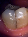 Cracked Molar 1