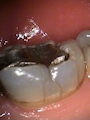 Cracked Molar 3