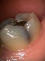 Cracked Molar 2