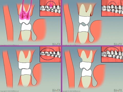 BadAntMolar