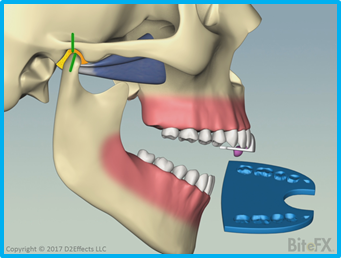 CR_Bite_Record_And_Mounting_341x258