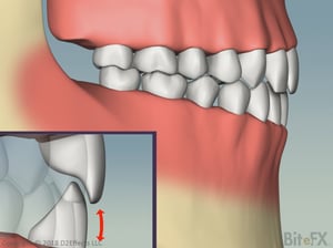 ChewingAndEnvelopeOfFunction-Vertical-Profile-1