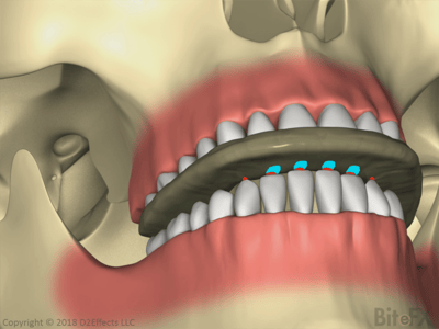 Flat-Plane-Splint-Asymptomatic