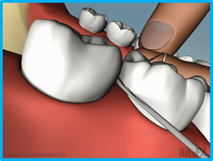 Flossing-2-308x233