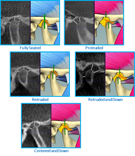 Kaspers-Five-Condylar-Positions