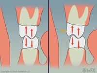 Molars-Contact-Comparions-After-Color-Change-1