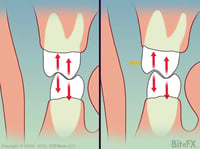 Molars-Contact-Comparions-Before-Color-Change