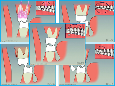 Molars-no-Guidance-with-Insets-5-Views-400x300