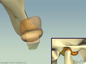 Retrodiscal-Perforation-Frame211