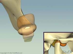 Retrodiscal-Perforation-Frame420