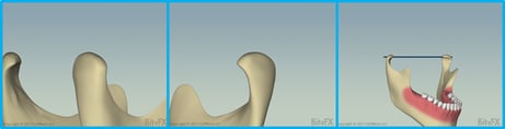 360-Condyle-Rotation-for-Newsletter.png