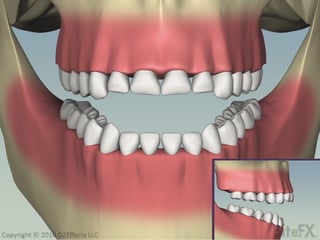 CorrectingSupraEruptionWithFrontToothWear-End-Before-Veneers.png