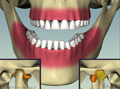 Disc Slip with Recapture - Front and Sides - Asymmetric Bite