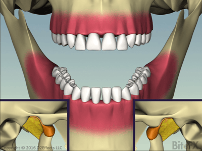 Disc Slip with Recapture - Front and Sides - Recaptured Disc