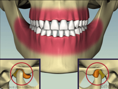 Disc Slip with Recapture - Front and Sides - Slipped Disc