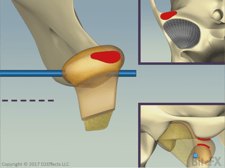 Disc-Healthy-Pressure-Path-With-Disc.png