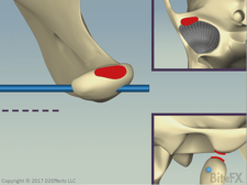 Disc-Healthy-Pressure-Path-Without-Disc.png