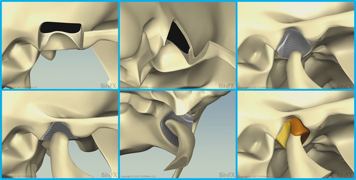 Fossa-Condyle-Rotation-Snapshots.png