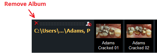 V3 Remove Album Button