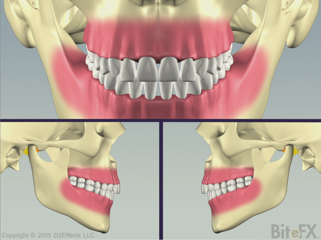 BilateralCondyleDeteriorationWithAdaptation